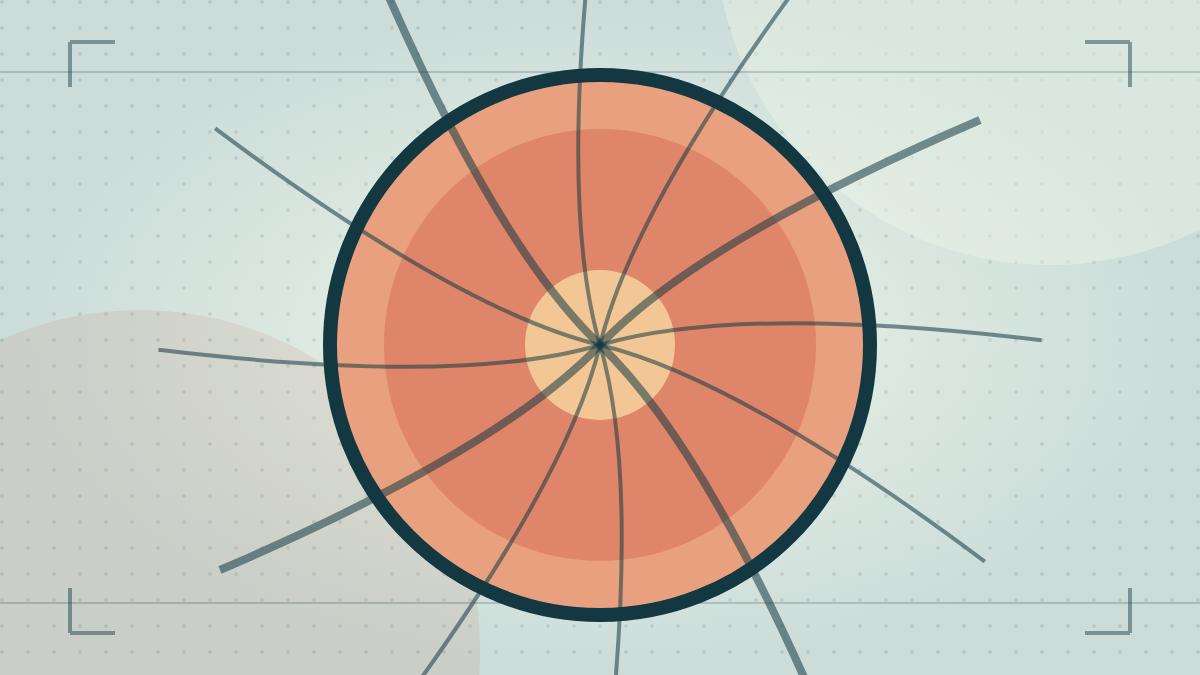 Illustration for Diabetes and your eyes: why screening matters